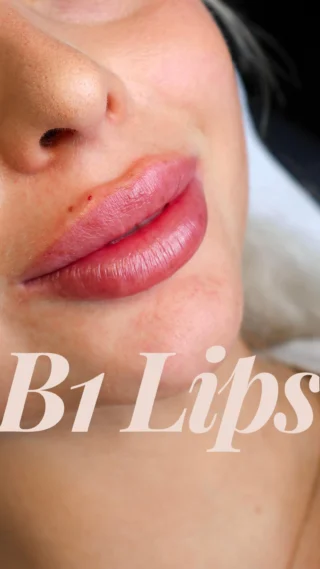 💋 Die schönsten Lippen in deiner Stadt – bei B1 Medical! ✨
 
Du wünschst dir vollere, harmonische Lippen, die auch natürlich aussehen? Unsere erfahrenen Ärzte und Ärztinnen zaubern dir das perfekte Lippenergebnis – mit definierter Kontur, einem schönen Lippenherz und individuell auf dich abgestimmt!

✅ Top Preis-Leistungs-Verhältnis
✅ Hochwertige Produkte & erfahrene Ärzt/-innen
✅ Schnelle Terminvergabe

Jetzt Termin sichern & endlich deine Traumlippen wahr werden lassen!

📍Dortmund, Düsseldorf, Wuppertal, Essen, Berlin | 📅 

📲 Vereinbare jetzt Deinen Wunschtermin unter dem Link in der Profilbeschreibung!